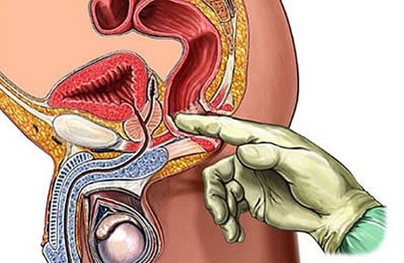Il massaggio prostatico come metodo per trattare la prostatite