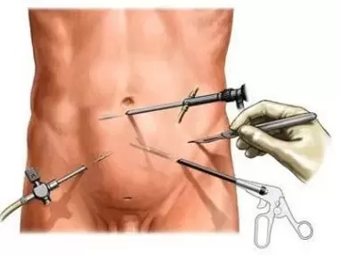 trattamento chirurgico della prostatite cronica