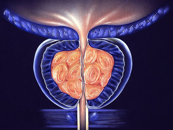 prevenzione della prostata infiammata e della prostatite